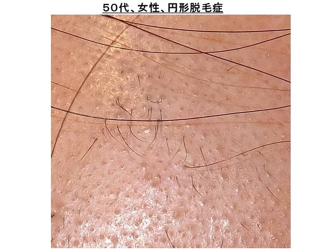 円形脱毛症　病院""